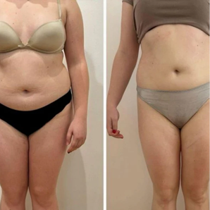 Före och efter Vacuslim 48, mage