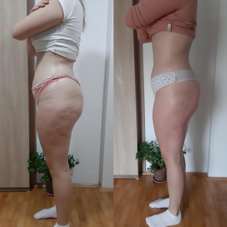 Före och efter Vacuslim 48, sida och lår